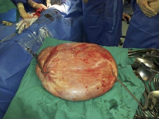 tumor_de_25_kilos